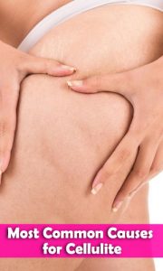 Most Common Causes for Cellulite