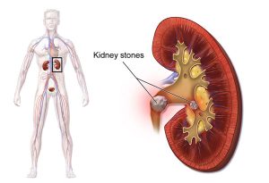 Natural Remedies For Kidney Stones