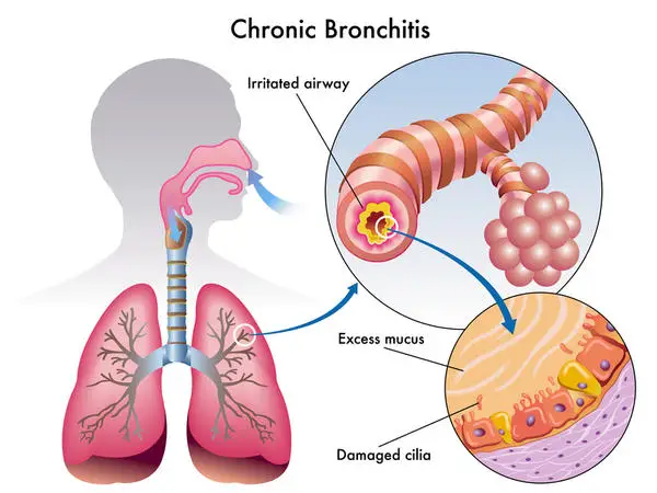 What is Bronchitis