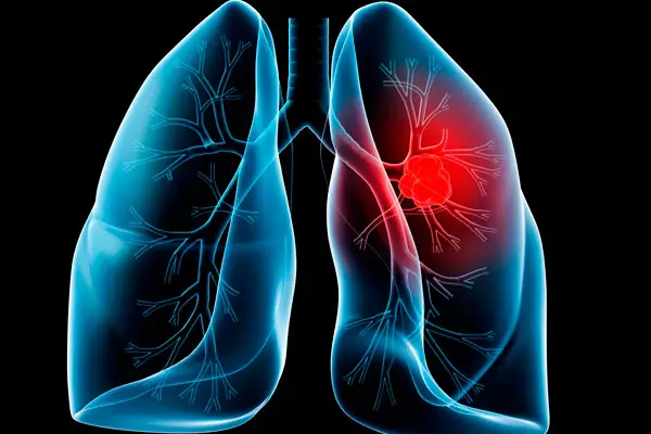 best natural remedies for lung cancer
