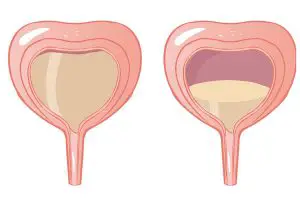 natural remedies for overactive bladder