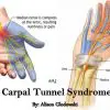 Natural Remedies for Carpal Tunnel