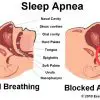 define sleep apnea