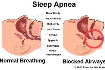 define sleep apnea
