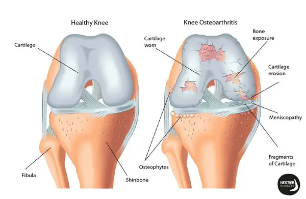  define osteoarthritis