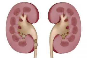 How to remove kidney stones naturally