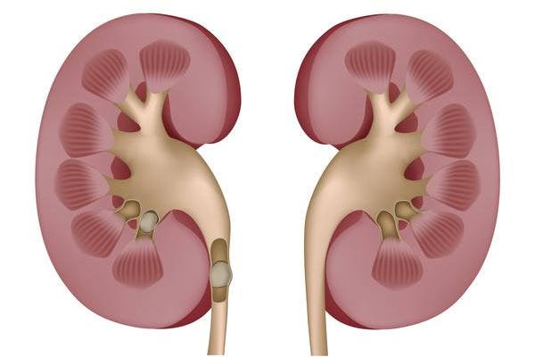How to remove kidney stones naturally