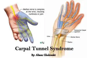 natural remedies for carpal tunnel